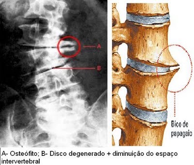 osteofitos2